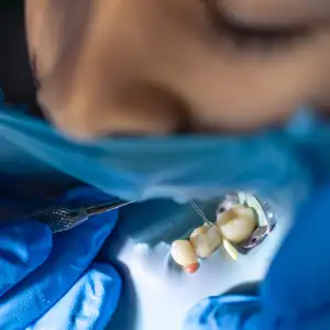 Recovery Timeline for Wisdom Teeth in San Francisco