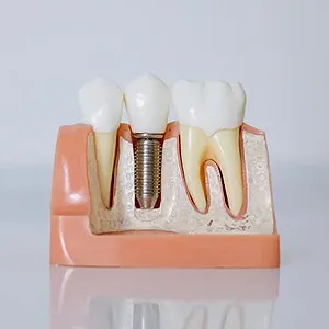 Myths vs. Facts About Dental Implants in San Francisco ?