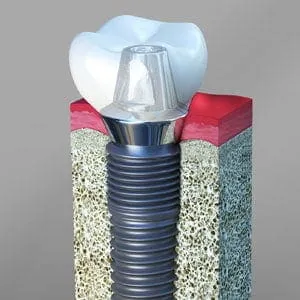 Are Dental Implants in San Francisco Right for Missing Teeth?