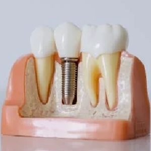 Dental Implants in San Francisco vs. Dentures: Which is Best?