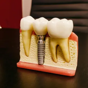 The Complete Guide to Full Mouth Dental Implants in San Francisco