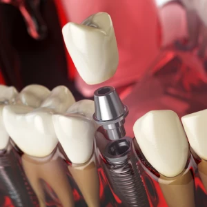Your Guide to the Best Dental Implants in San Francisco