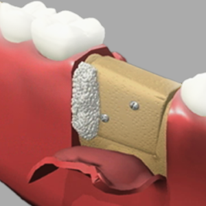 5 Key Questions About Bone Grafting in San Francisco