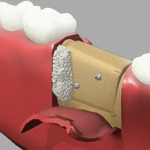 Who Is a Good Candidate for Bone Grafting in San Francisco?