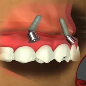 Teeth In An Hour